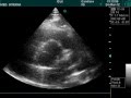 Bicuspid Aorta View In Doppler Echocardiography Bicuspid Aorta View In Doppler Echocardiography