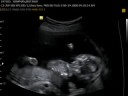 Baby Bowman (18 Weeks) 2