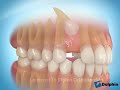Treatment of Impacted Eye-Teeth (Canines)