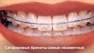 Разновидности брекетов