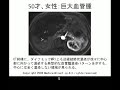 ???????giant hepatic cavernous hemangioma