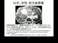 巨大肝血管腫 giant hepatic cavernous hemangioma