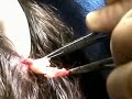 Pilar Cyst Treatment Remove From Head