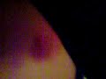 Heart-Shaped Hickie!