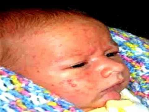 how to treat a baby acne