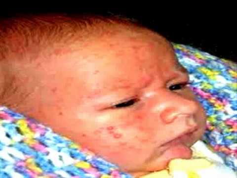 how to baby acne