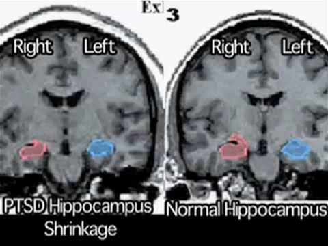 PTSD & Parkinson's Disease: Longer ...