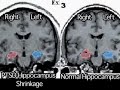 PTSD & Parkinson\