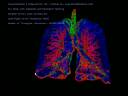 These video clips are based on a lung volume segmentation paper, which is now under review. (Copyright, Jiantao Pu, jip13@pitt.edu, http://sites.google.com/site/pujiantao)