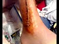Fractura tibia y perone