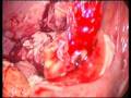 Acute appendicitis with peritonitis.mpg