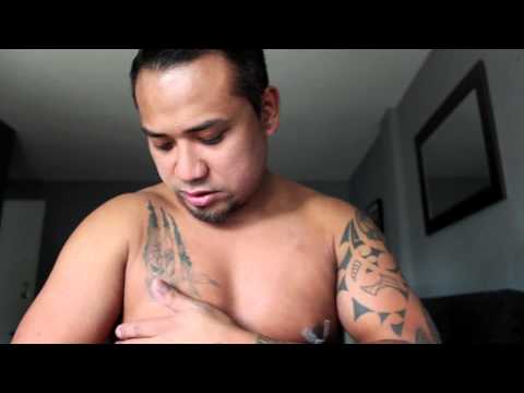 how to perform gynecomastia surgery