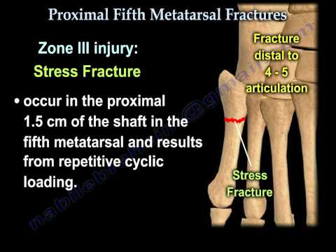 how to treat jones fracture