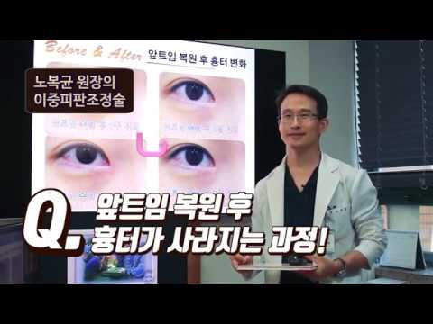 앞트임복원 수술 후 앞트임흉터 회복 과정, 회복기간에 대해 알려드립니다
