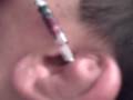 MMA Ritchiez Cauliflower Ear after Sparring
