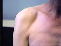 Motor Neuron Disease Motor Neuron Disease