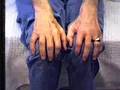 Motor Neuron Disease