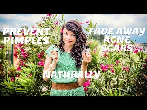 how to prevent acne naturally