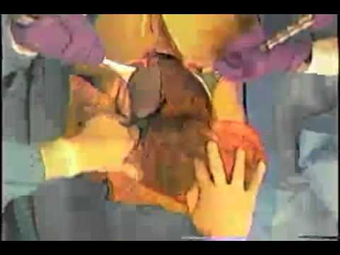 how to perform kocher maneuver