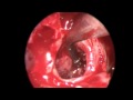 Endoscopic endonasal transsphenoidal adenomectomy.mov