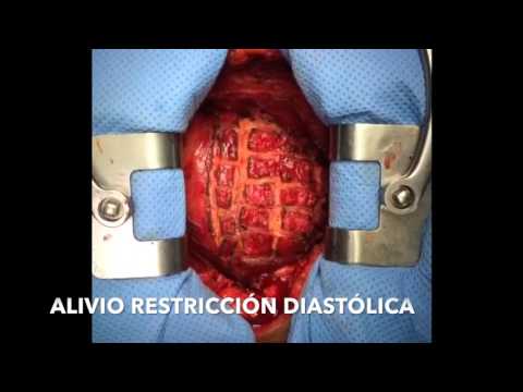 Pericarditis Constrictiva: pericardiectomía e incisiones epicárdicas en damero Pericarditis Constrictiva: pericardiectomía e incisiones epicárdicas en damero