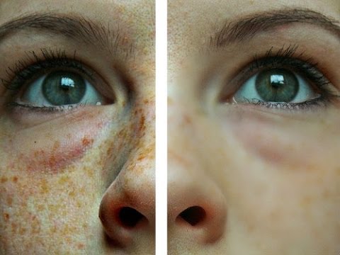 video-linktoworks-How to Get Rid of Freckles