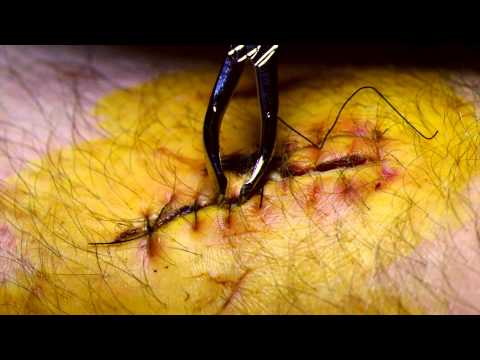 how to tell if stitches are healing properly