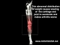 Genu Verus or Bowlegged knees by Dr Farshchian