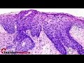 Insidermedicine in 60 - November 15, 2007  Diabetes Metformin