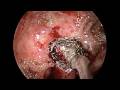 Cocaine Abuse as a Cause of Nasal Destruction Cocaine Abuse as a Cause of Nasal Destruction