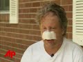 mans nose bitten off in fight