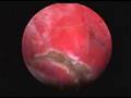 Hysteroscopic Polypectomy