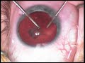 cataract surgery posterior lenticonus pediatric Uday Devgan cataract surgery posterior lenticonus pediatric Uday Devgan