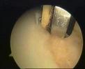 Arthroscopy on my knee