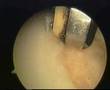 Arthroscopy on my knee