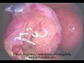 Tubal Ectopic Pregnancy Laparoscopic Salphingotomy