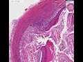 Histopathology Skin--Epidermal inclusion cyst