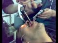 A bizarre removal of a wrench from a patient stomach
