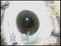 Use of Healon 5 in Floppy Iris Cataract Surgery Use of Healon 5 in Floppy Iris Cataract Surgery