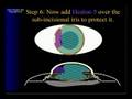 Floppy Iris Syndrome, Cataract Surgery Floppy Iris Syndrome, Cataract Surgery