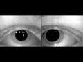 Vertical Nystagmus