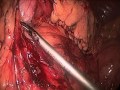 Vagal Sparing Resection Of Esophagus Vagal Sparing Resection Of Esophagus
