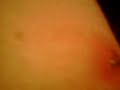 big ass zit on my leg tried to pop it 1 week before thats y its black and blue it finaly got a head and its on now