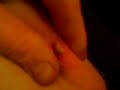 big ass zit on my leg tried to pop it 1 week before thats y its black and blue it finaly got a head and its on now