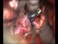 Surgery of Particularly Complex Aneurysm - New Clip System for Aneurysms 