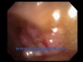 Polypectomy- Colon Polyp Removal by Gupta Gastro Associates