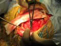 Occipital Transtenorial Approach