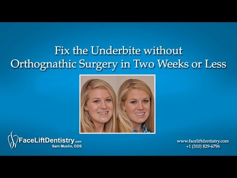 how to fix underbite
