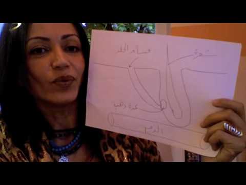 Acne حب الشباب  .. أسبابه وعلاجه