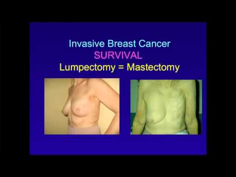 how to treat stage 0 breast cancer